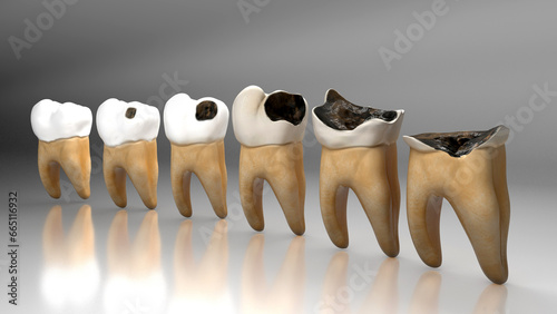 Human Tooth Decay A 3D Dental Caries Progression 3d Model