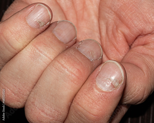 The recovery process of a Caucasian hand after scarlet fever, displaying nail damage and renewal photo