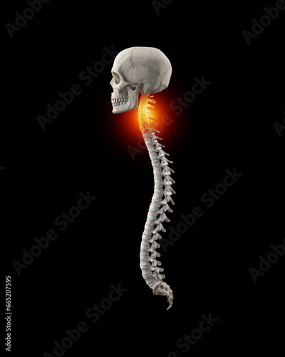 Human spine with lumbar with pain in cervical region photo