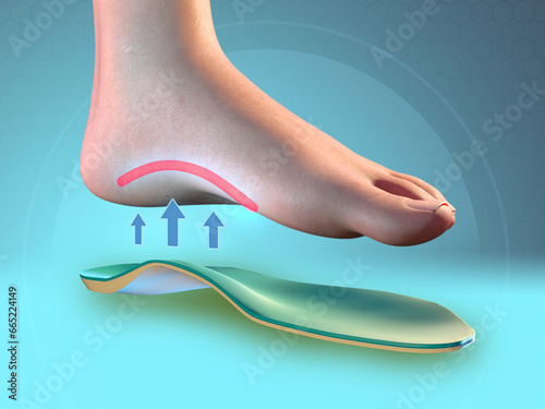 Foot arch support