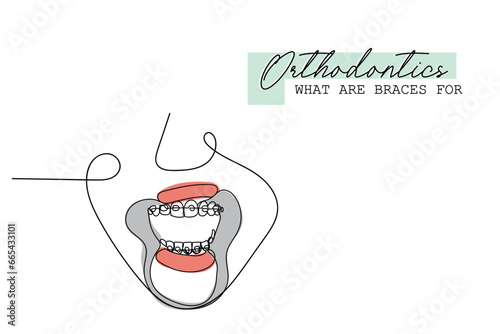  line art of Orthodontic treatment. Dentists day and respect for their services to humanity. Dental procedures vector art concept. Isolated vector of teeth and jaws. Retainers braces denture