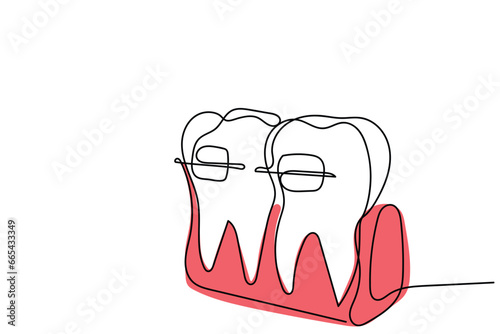  line art of Orthodontic treatment. Dentists day and respect for their services to humanity. Dental procedures vector art concept. Isolated vector of teeth and jaws. Retainers braces denture