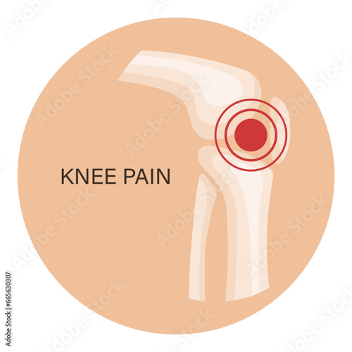 Knee pain, osteoarthritis, rheumatoid arthritis. Anatomy of human bones. Medicine. Illustration, vector
