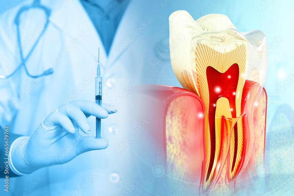Dental injection. local Dental anesthesia. human jaw with intraligamentary anesthesia procedure