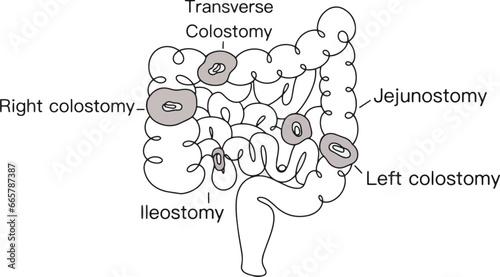 Intestines. Stoma. Medicine. One line