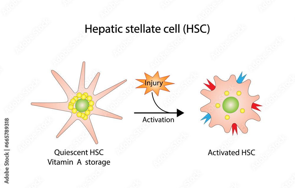Hepatic stellate cell, HSC. Quiescent HSC vitamin A storage. Activated HSC, collagen deposition. Liver fibrosis. vector illustration. - obrazy, fototapety, plakaty 