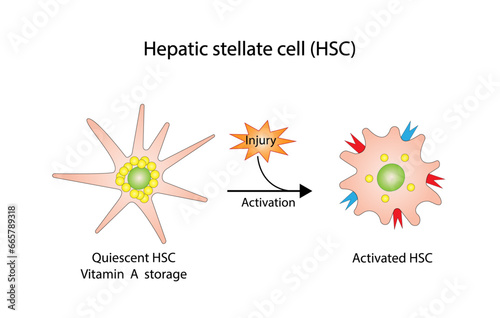 Hepatic stellate cell, HSC. Quiescent HSC vitamin A storage. Activated HSC, collagen deposition. Liver fibrosis. vector illustration.