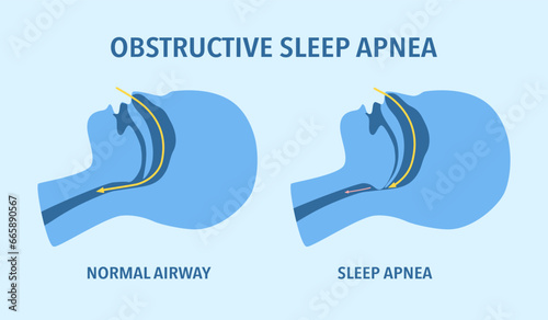 Obstructive sleep apnea concept. Sleep disorder.