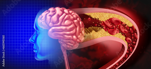 Brain Stroke Attack as a Cerebral arteriosclerosis disease as a blocked artery due to plaque buildup
