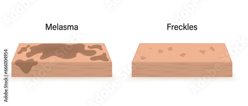 The difference between skin with melasma and skin with freckles. Human skin layer anatomy vector.