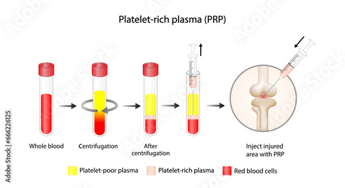 Platelet-rich plasma (prp). Autologous conditioned plasma, is a concentrate of PRP extracted from whole blood. After centrifugation, extract PRP and inject knee. Vector Illustration.