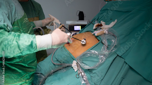 Obesity surgery. Weight loss surgery is performed with laparoscopic surgery. Operating room doctor and team performing surgery