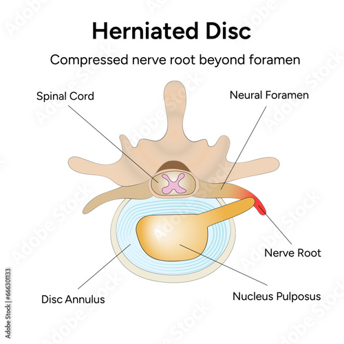 Herniated disc, compressed nerve root beyond foramen cartoon