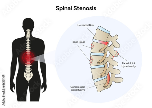 Spinal stenosis disease medical infographic in vector