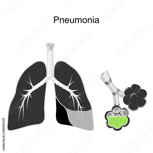Pneumonia. Cross section of human lungs and alveolus with green fluid