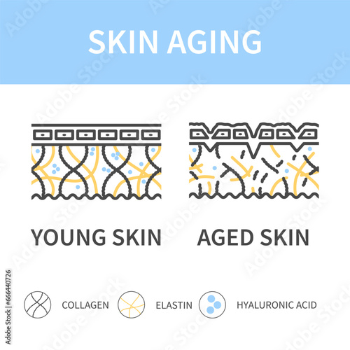 Young skin versus aged skin cross section diagram. Firm skin becoming saggy with low levels of collagen, elastin and hyaluronic acid. Linear vector illustration.