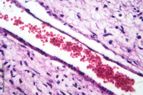 A small blood vessel with red blood cells in neurofibroma tissue sample, light micrograph