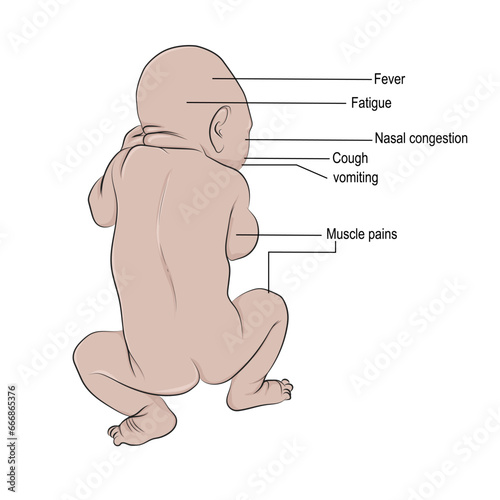 main symptoms of the flu in a baby.