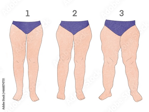 Bild auf Leinwand Piernas con tres estadios de lipedema