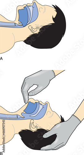 Adenoid hypertrophy ear ENT cold neck nose pain Sore acute apnea gland media mouth nasal sinus sleep treat viral airway common facies otitis