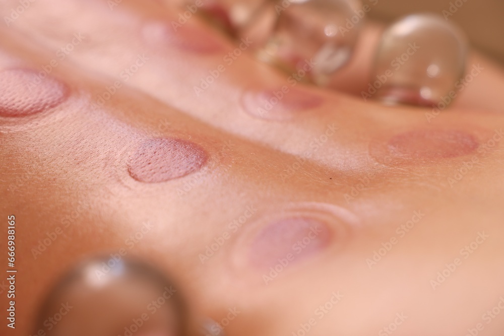 Fototapeta premium Cupping therapy. Closeup view of man with glass cups on his back indoors