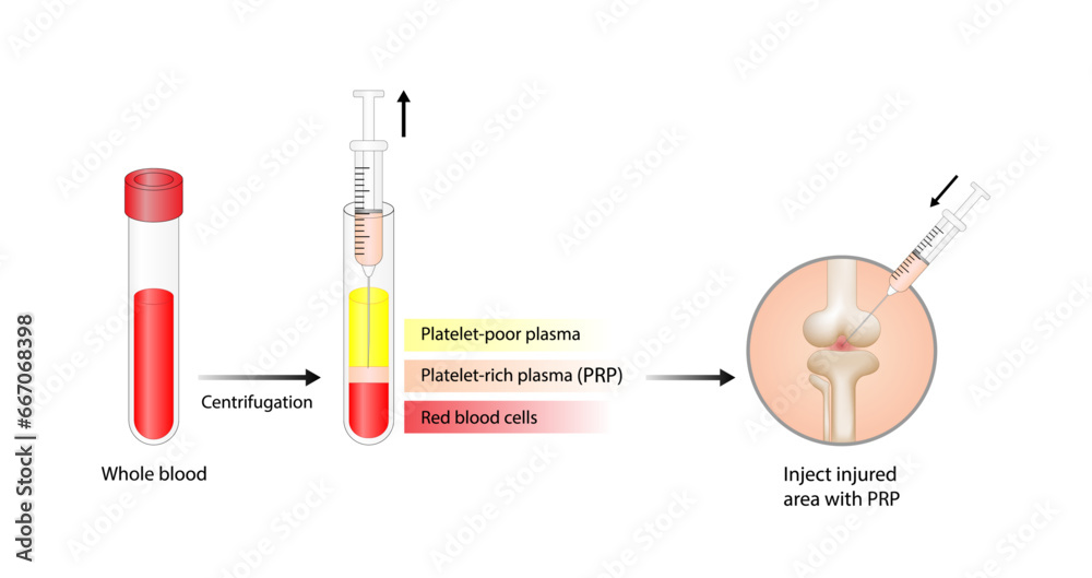Platelet-rich plasma (prp). Autologous conditioned plasma, is a ...
