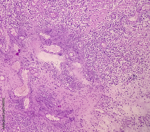 Ear (biopsy): Microphotograph of Granulation tissues, show dense infiltration of polymorphs, lymphocytes, histiocytes and foreign body giant cell. proliferation of fibroblasts, keratinocytes. photo