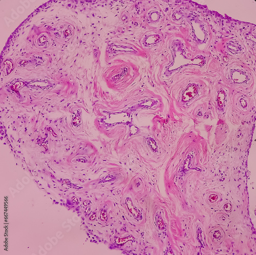 Microscopic image of Synovial tissue of knee joint. Baker's cyst. Ganglion cells, show microscopic view cyst wall composed of hyalinized fibrocollagenous tissue lined by synovium. photo