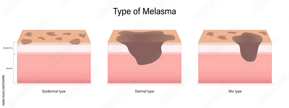 Type of melasma vector. Epidermal, Dermal and mix type. Facial skin problems.