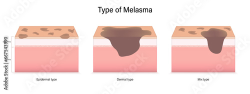 Type of melasma vector. Epidermal, Dermal and mix type. Facial skin problems. photo