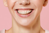 Close up cropped toothy smile of young happy woman with dental braces on teeth isolated on plain light pastel pink color background studio portrait. Dental healthy care with orthodontic accessories.