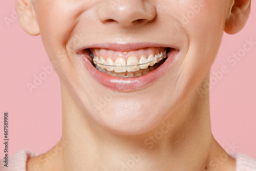 Close up cropped toothy smile of young happy woman with dental braces on teeth isolated on plain light pastel pink color background studio portrait. Dental healthy care with orthodontic accessories.