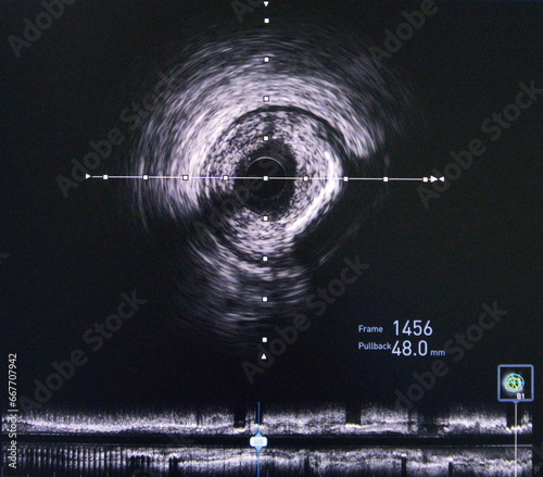 Intravascular ultrasound (IVUS) was performed cross-sectional and longitudinal of coronary artery.