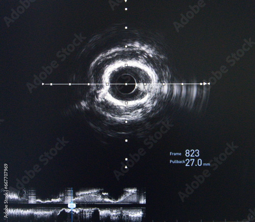 Intravascular ultrasound (IVUS) was performed cross-sectional and longitudinal of coronary artery. photo