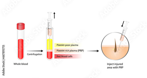 Platelet-rich plasma (prp). Autologous conditioned plasma, is a concentrate of PRP extracted from whole blood. After centrifugation, extract PRP and inject skin or hair. Vector Illustration.