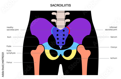 Sacroiliitis medical poster