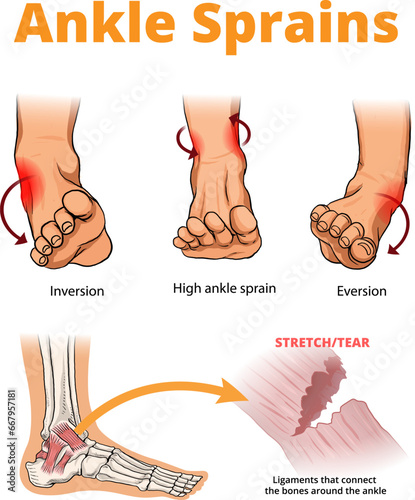 illustration of ankle sprains types
