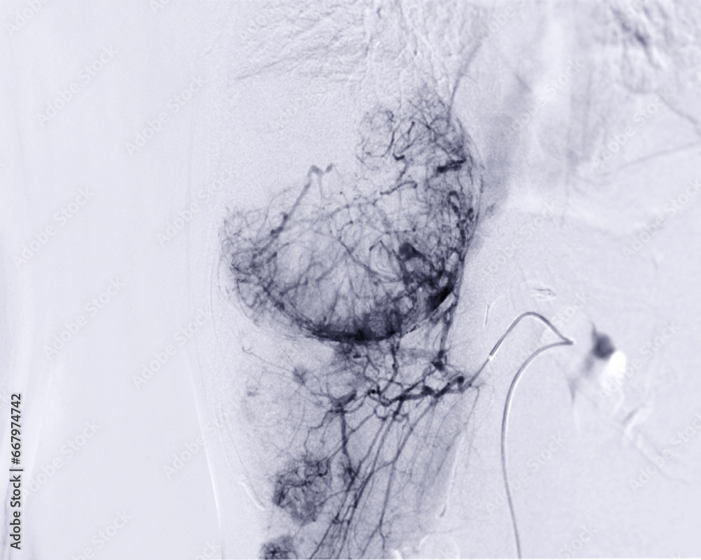 Transarterial Chemoembolization (TACE) is a medical procedure used to ...