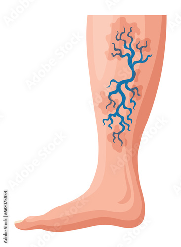 Stages or types of varicose veins development. Medical poster or disease infographic. Image of diseased legs. Vector illustration in flat style