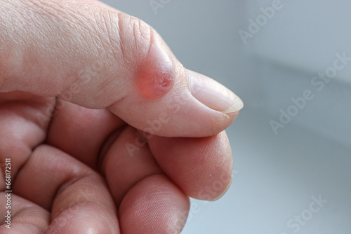 Ganglion cyst (synovial cyst disease) on the thumb of a woman’s hand. Selective focus. photo
