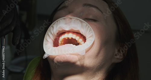 Tableau sur toile Dentist removes the remains of filling, braces from patient's mouth with princet
