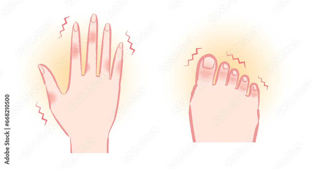 Obraz premium しもやけ・凍瘡で痒そうな手と足の指のイラストセット
