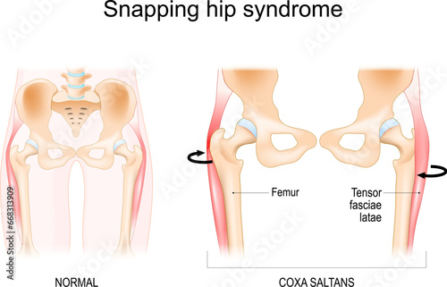 Snapping hip syndrome. Coxa saltans.