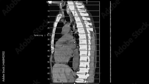 Diaphragmatic hernia  or Hiatus hernia, CT scan
 photo