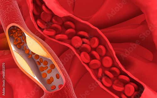 Clogged arteries on scientific background. 3d illustration.. photo