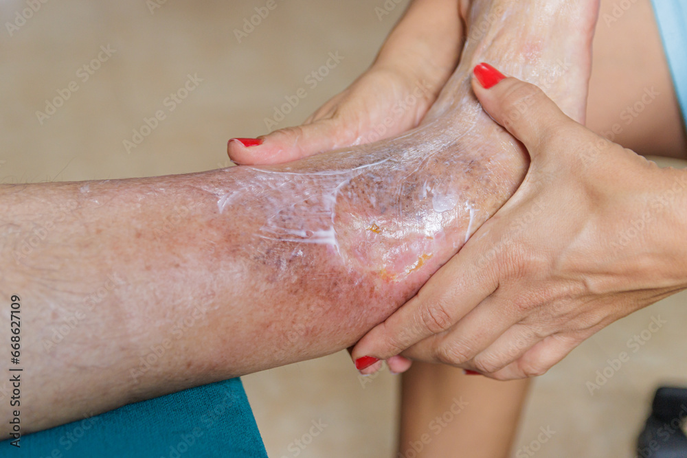 Home health care for an elderly person. Leg with ulcer due to diabetes. - obrazy, fototapety, plakaty 