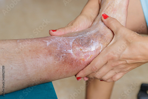 Home health care for an elderly person. Leg with ulcer due to diabetes. photo