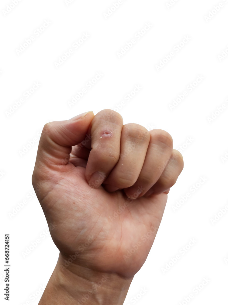 Hands infected with a skin infection, Human Papilloma Virus, or the lining of wounds or abrasions through direct contact with a person with warts. and may infect the skin itself. white background Hands infected with a skin infection, Human Papilloma Virus, or the lining of wounds or abrasions through direct contact with a person with warts. and may infect the skin itself. white background