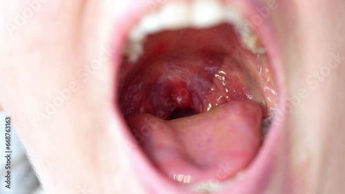 An open mouth of a woman indicates severe inflammation of the throat, red coloration of the mucous membrane, pharyngitis.