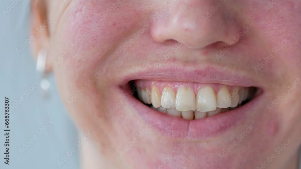 Smile of a woman with a dental stone closeup, dentistry. Big teeth